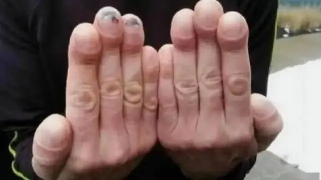 4 Changes in Your Fingers That Could Be Signs of Lung Can.cer – See a Doctor Immediately!