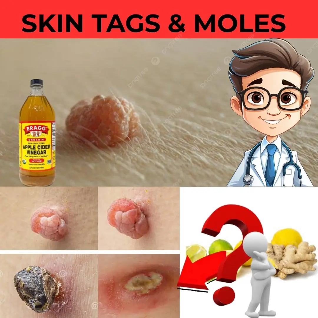 Leg Pain, Rheumatism, Varicose Veins, Arthritis – Natural Remedy with Cloves & Garlic! 🧄🌿