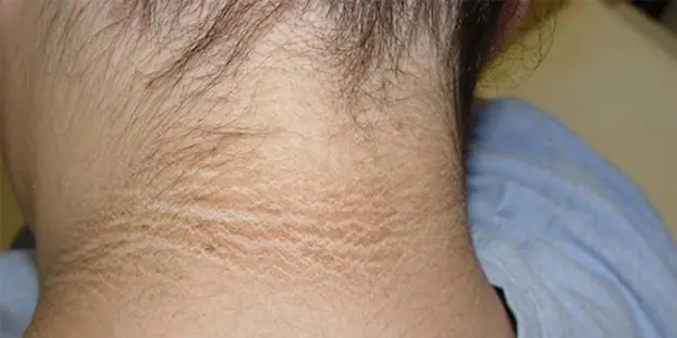 People at Risk of Cancer Often Show 3 Warning Signs in the Neck – Early Checkups Can Save Lives