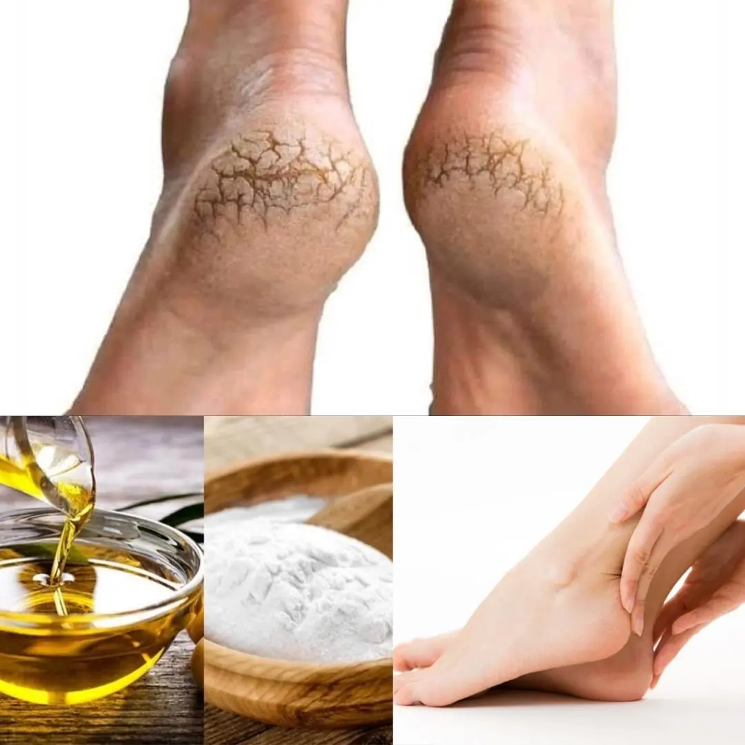 Get Baby-Soft Heels: Olive Oil and Baking Soda for Cracked Heels