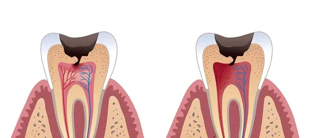 Tooth Decay: Causes, Types, and How to Prevent It