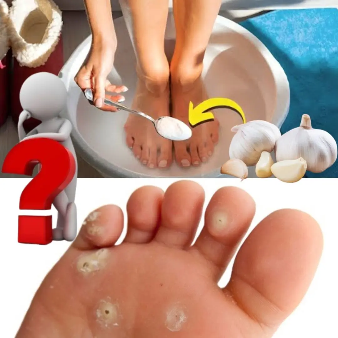 Eliminate Plantar Warts with These Natural Garlic Remedies