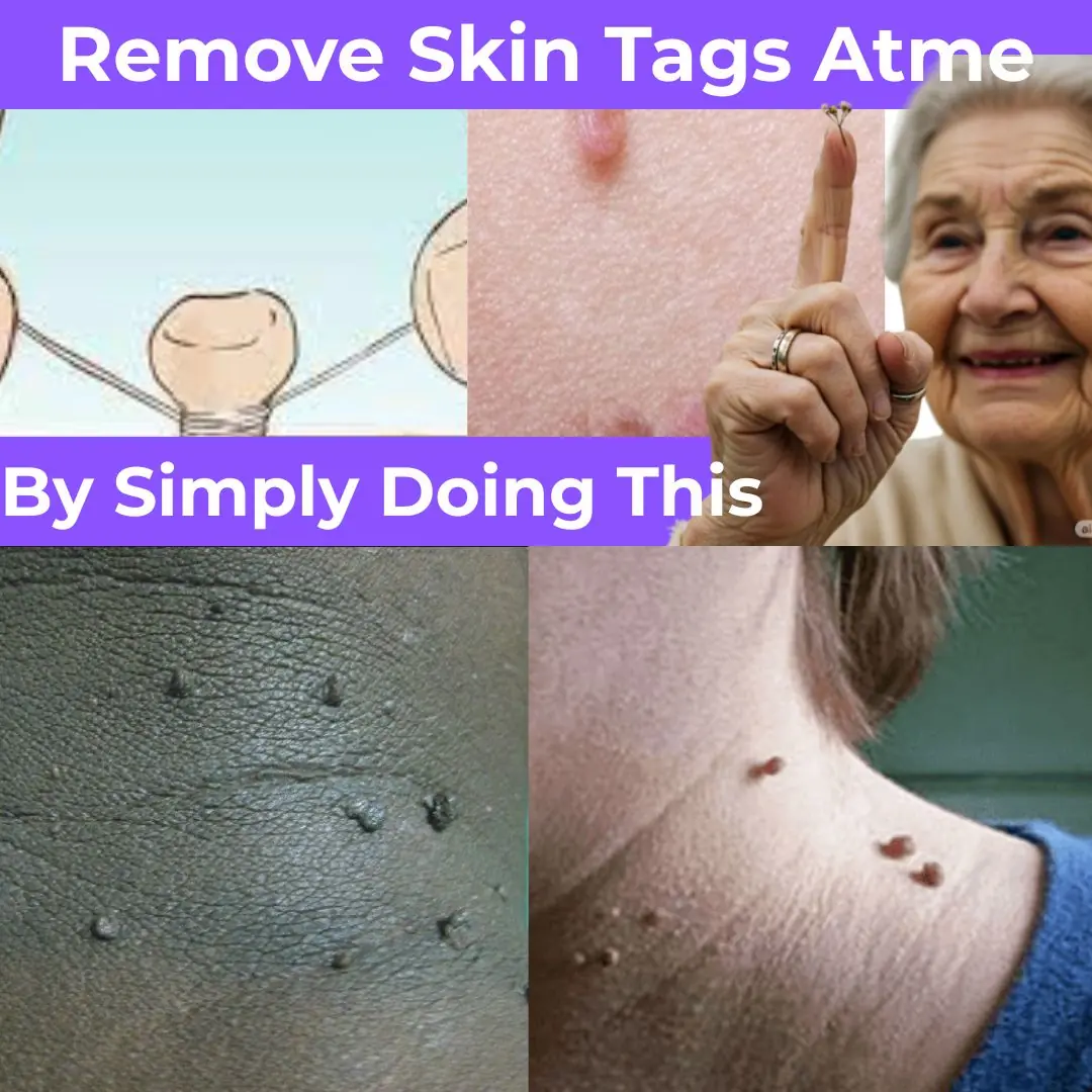 Plantar Warts and Skin Tags Disappear Overnight with this recipe