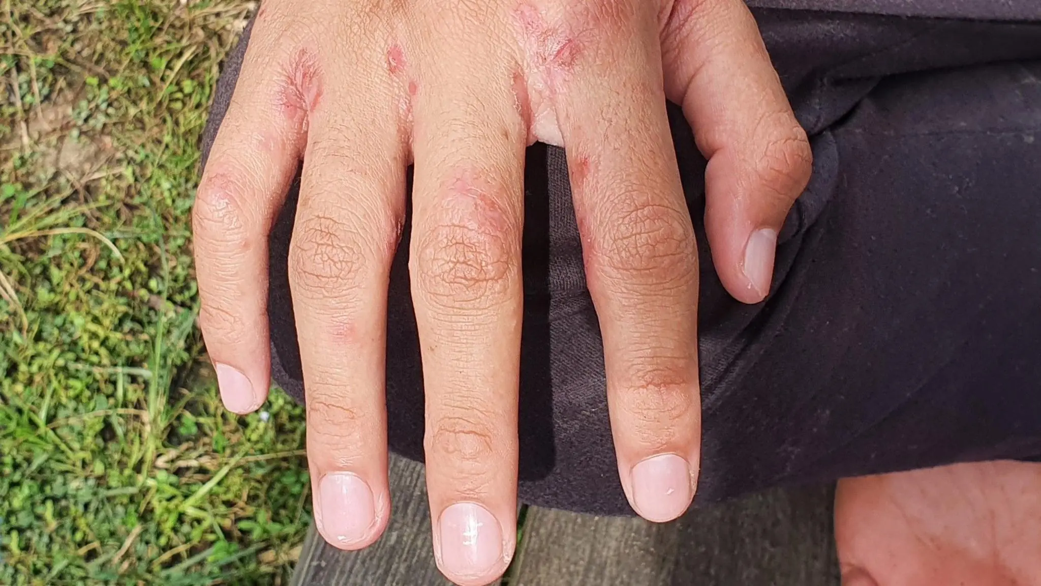 Red Dots on Your Skin? Why You Shouldn’t Ignore These Early Signs of Scabies