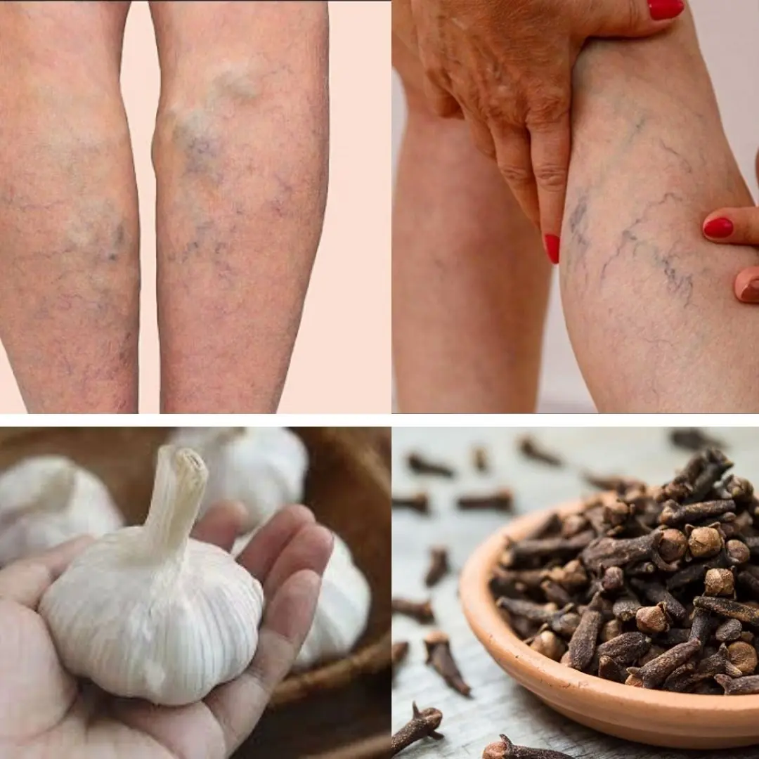 🧄🌿 Natural Remedy for Leg Pain, Rheumatism, Varicose Veins & Arthritis with Cloves and Garlic
