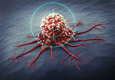 Breakthrough Cancer Treatment Uses Ultrasound and Microbubbles to Destroy Tumors from Within