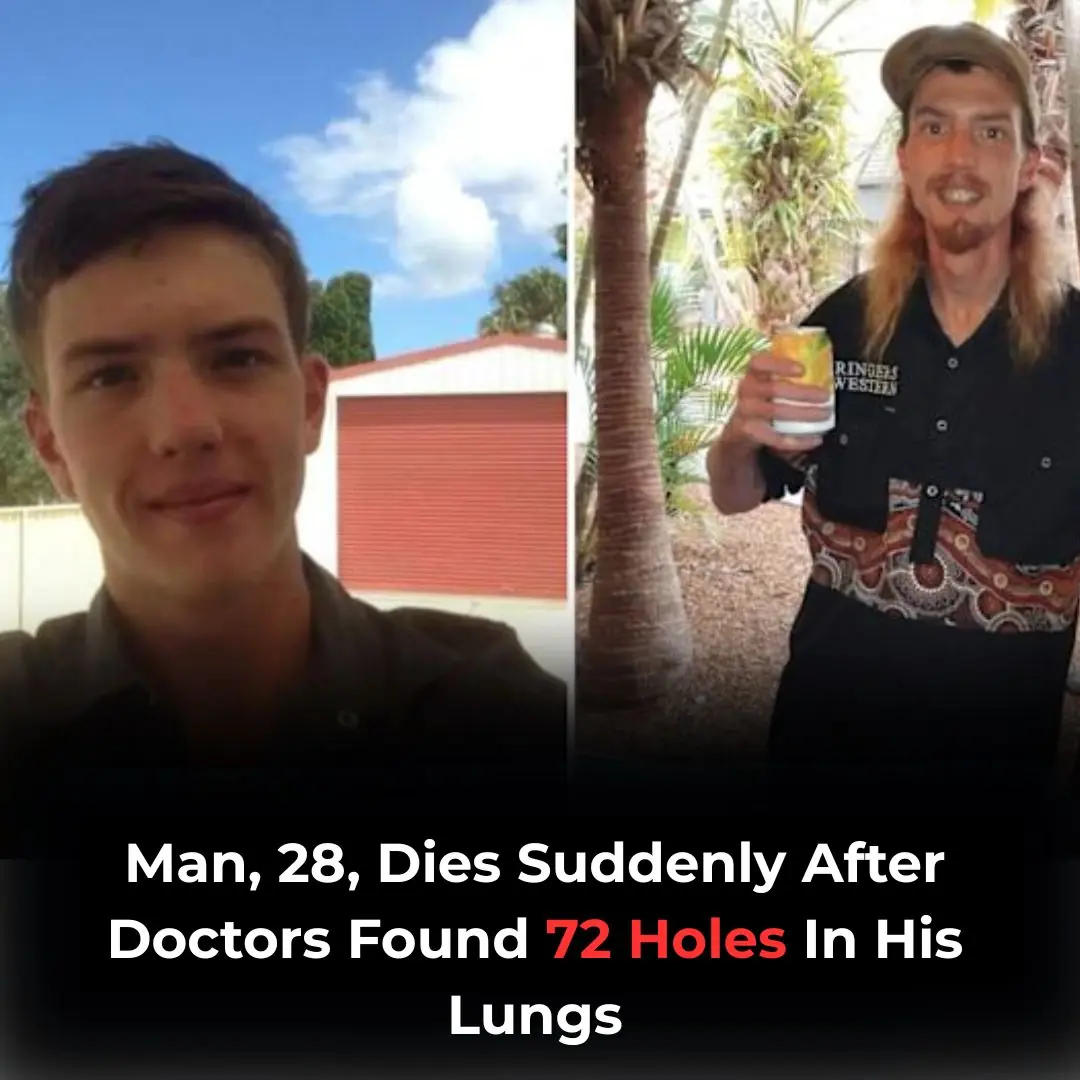 Man, 28, Passes Away Suddenly After Doctors Discover 72 Irreparable Holes In His Lungs