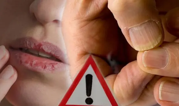 Experts Reveal 3 Warning Signs of Lip and Nail Cancer You Shouldn’t Ignore