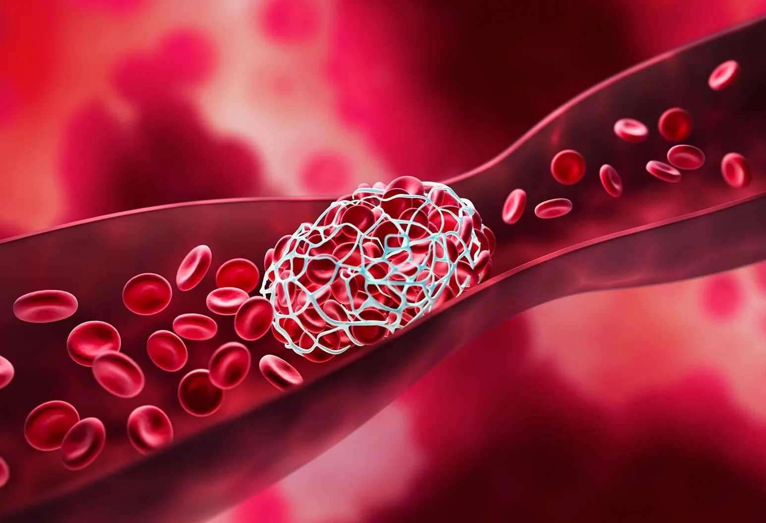 When There's a Blood Clot in the Body, It May Send You 4 Warning Signals You Shouldn't Ignore
