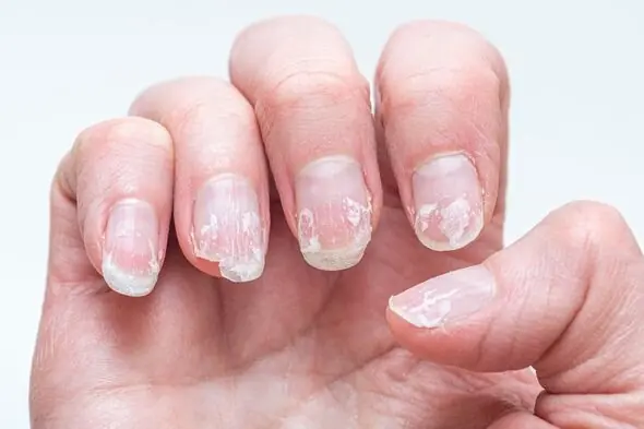 Warning: Strange Nail Shapes Could Be a Sign of Dangerous Cancer