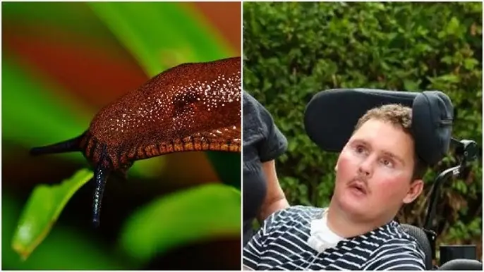 Man Eats Slug on a Dare, Leading to Tragic Consequences Years Later