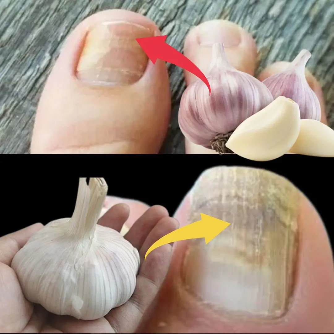 This Natural Nail Fungus Killer Works Fast: Garlic!