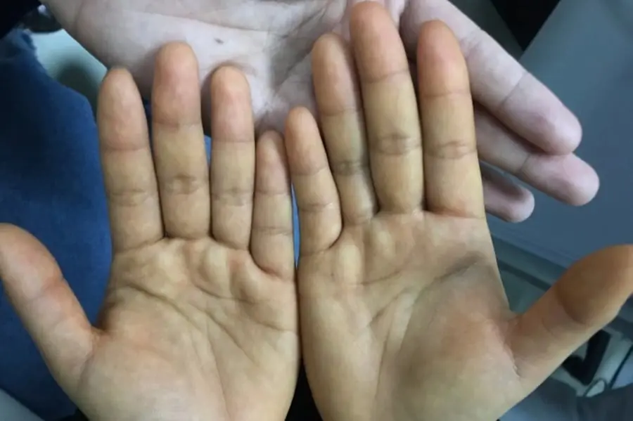 Before Cancer Knocks: 4 Warning Signs in Your Hands and Feet You Should Never Ignore