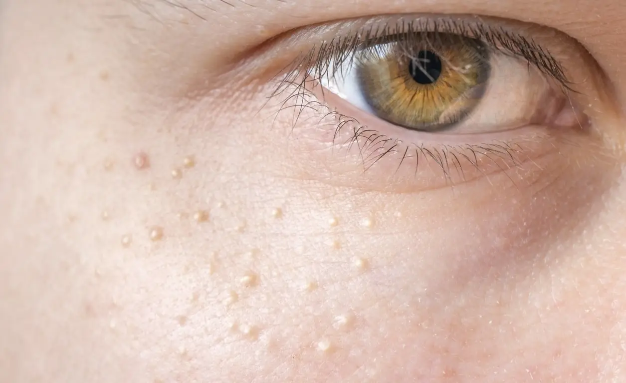 If You Have Tiny White Bumps on Your Face, Don’t Try to Remove Them!