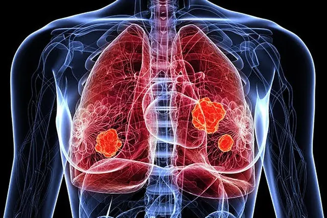 5 Changes in Hands and Feet That May Signal Lung Cancer Is Coming – But Most People Mistake Them for Common Illnesses