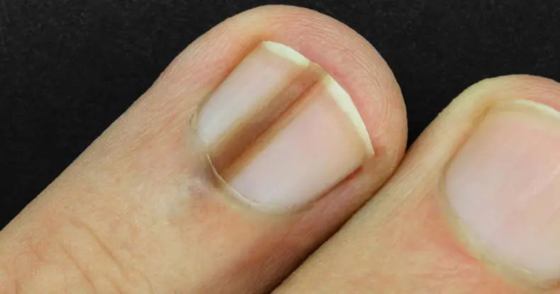 Viral Photo Sparks Cancer Concern After Man Shares Dark Line on Finger