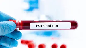 What Is an ESR Test? Understanding the Erythrocyte Sedimentation Rate and Its Role in Detecting Inflammation