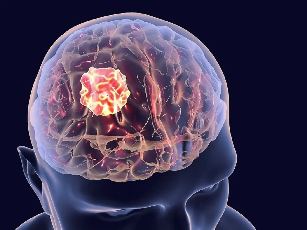 How Dangerous Are Brain Tumors? If You Have These Symptoms, Get Checked Before It's Too Late
