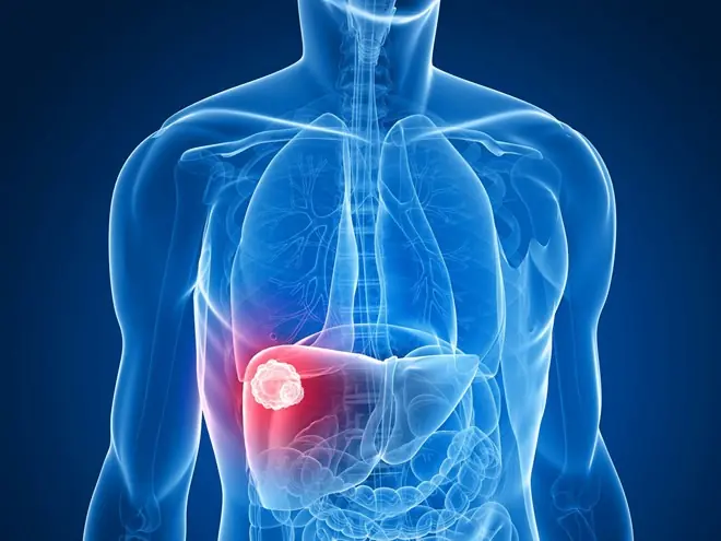 47-Year-Old Man Dies of Liver Cancer: ‘2 Pains and 2 Itches’ Could Be Warning Signs of Liver Disease