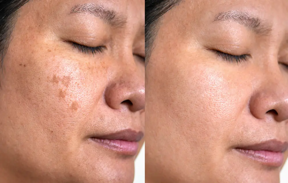 How to Reduce Age Spots: Causes, Treatments, and Prevention