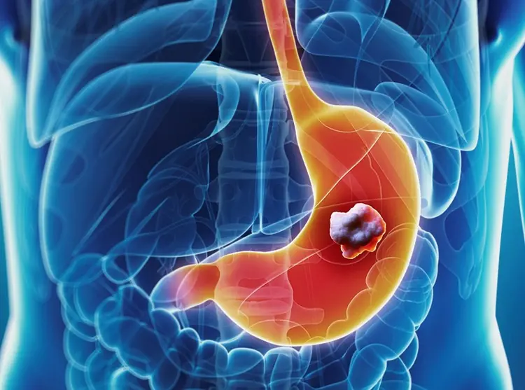 7 Early Signs of Stomach Cancer Everyone Should Know to Prevent Metastasis