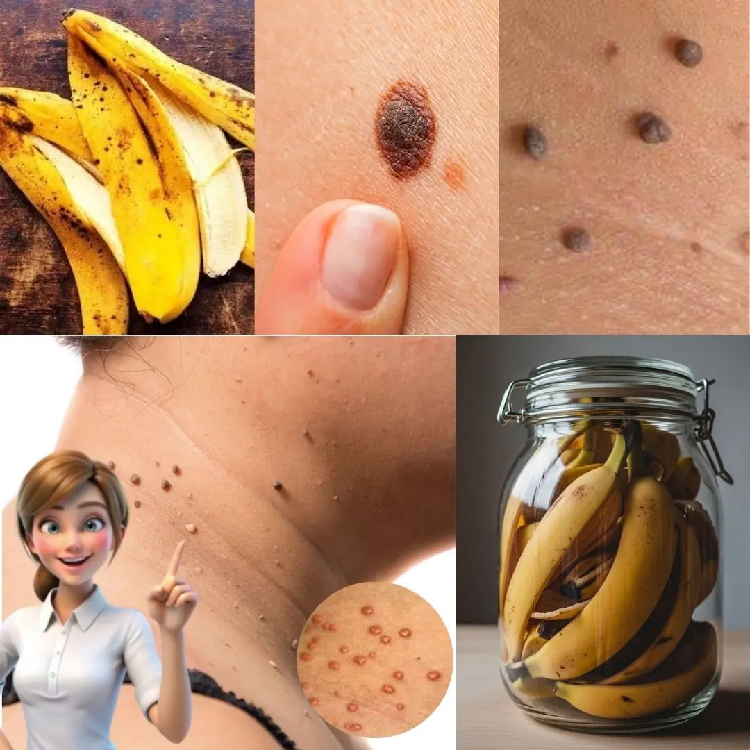 How to Remove Skin Tags on Your Face Naturally with Banana Peel and Other Safe Remedies