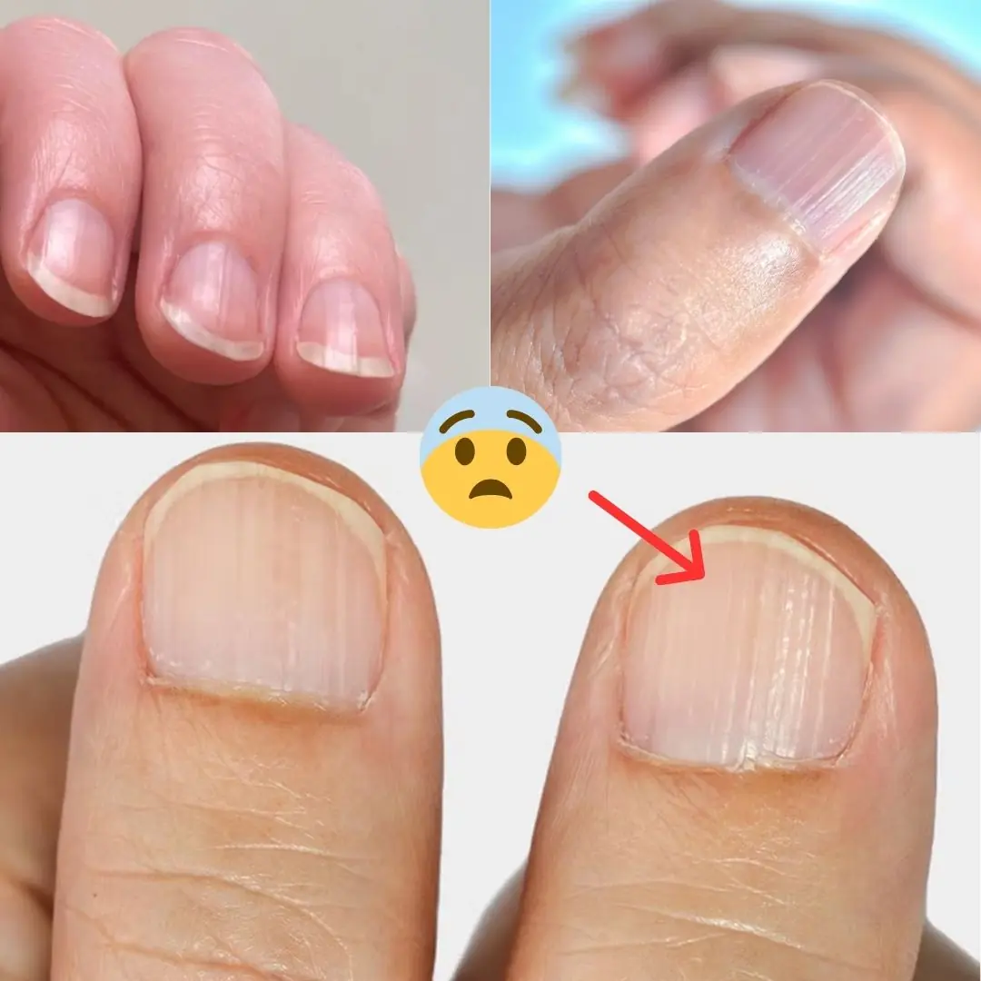 Doctor Reveals 7 Health Issues Hidden in Your Nails