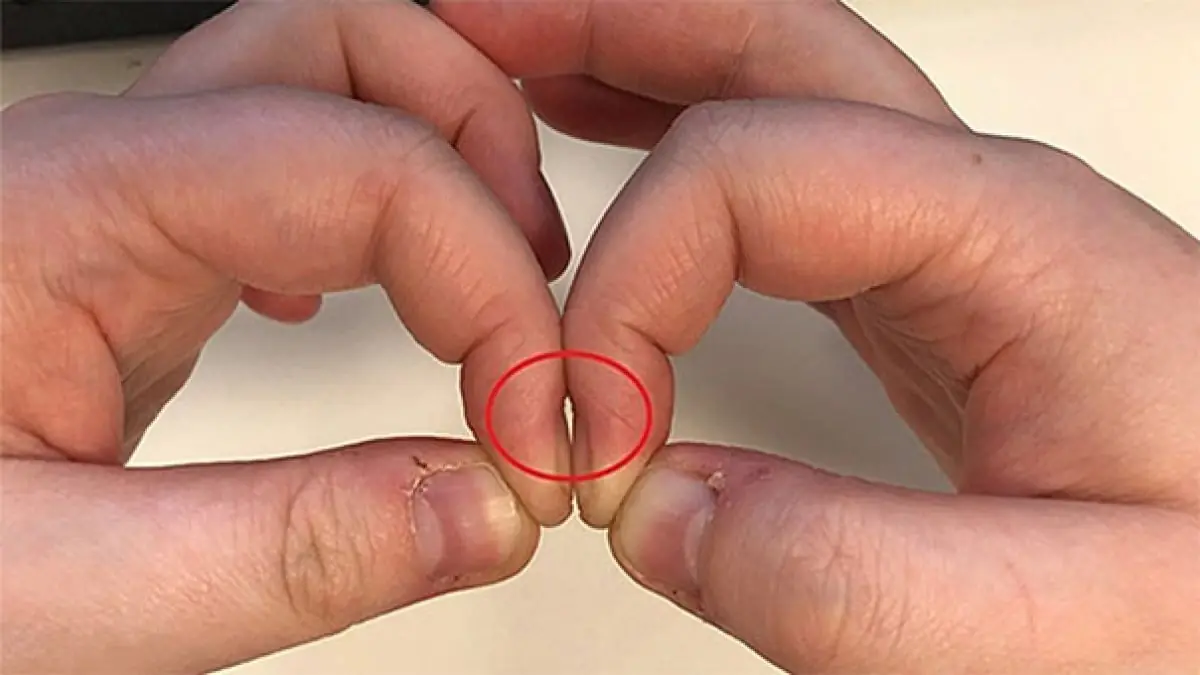 Placing Two Fingertips Together to Detect Lung Cancer: A Quick Test Doctors Use