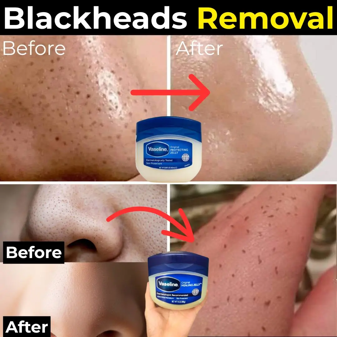 How to Remove Blackheads and Whiteheads from Nose and Face Naturally at Home – With Vaseline and a Simple Trick
