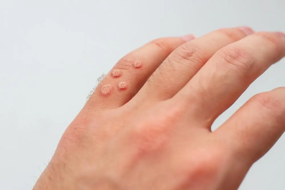 Warts on Hands: Causes and Effective Natural Treatments
