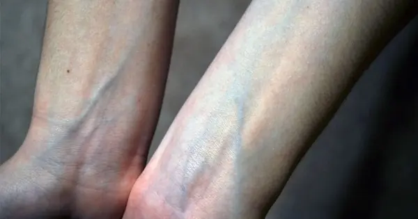 If You See Someone with Prominent Blue Veins, You Must Tell Them This — It Could Save Their Life