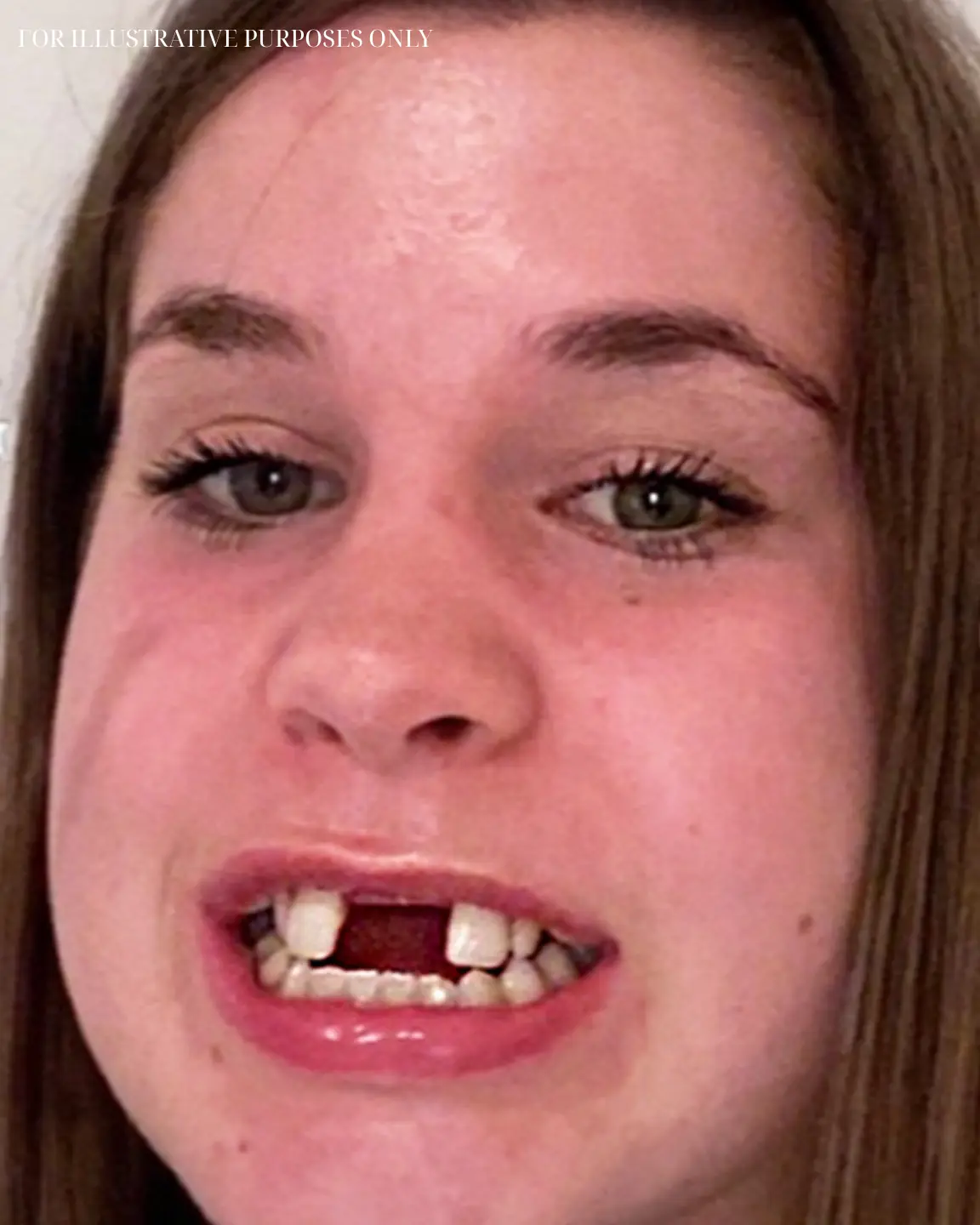 This Girl Spent 6 Years Fixing Her Jaw & After the Final Surgery, She Stunned Everyone with the Results – Her Transformation in Pics