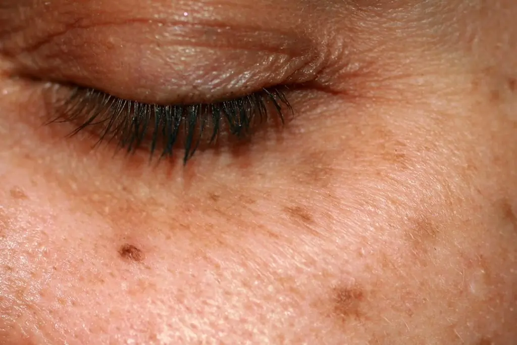 How to Fade Age Spots: Causes, Treatments, and Prevention That Actually Work