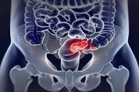 Powerful Simulation Reveals How Cancer Progresses and Ultimately Causes Death