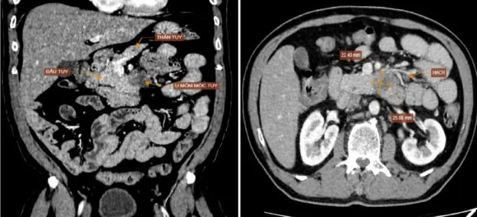 Discovered to Have One of the Deadliest Cancers After Just One Warning Sign