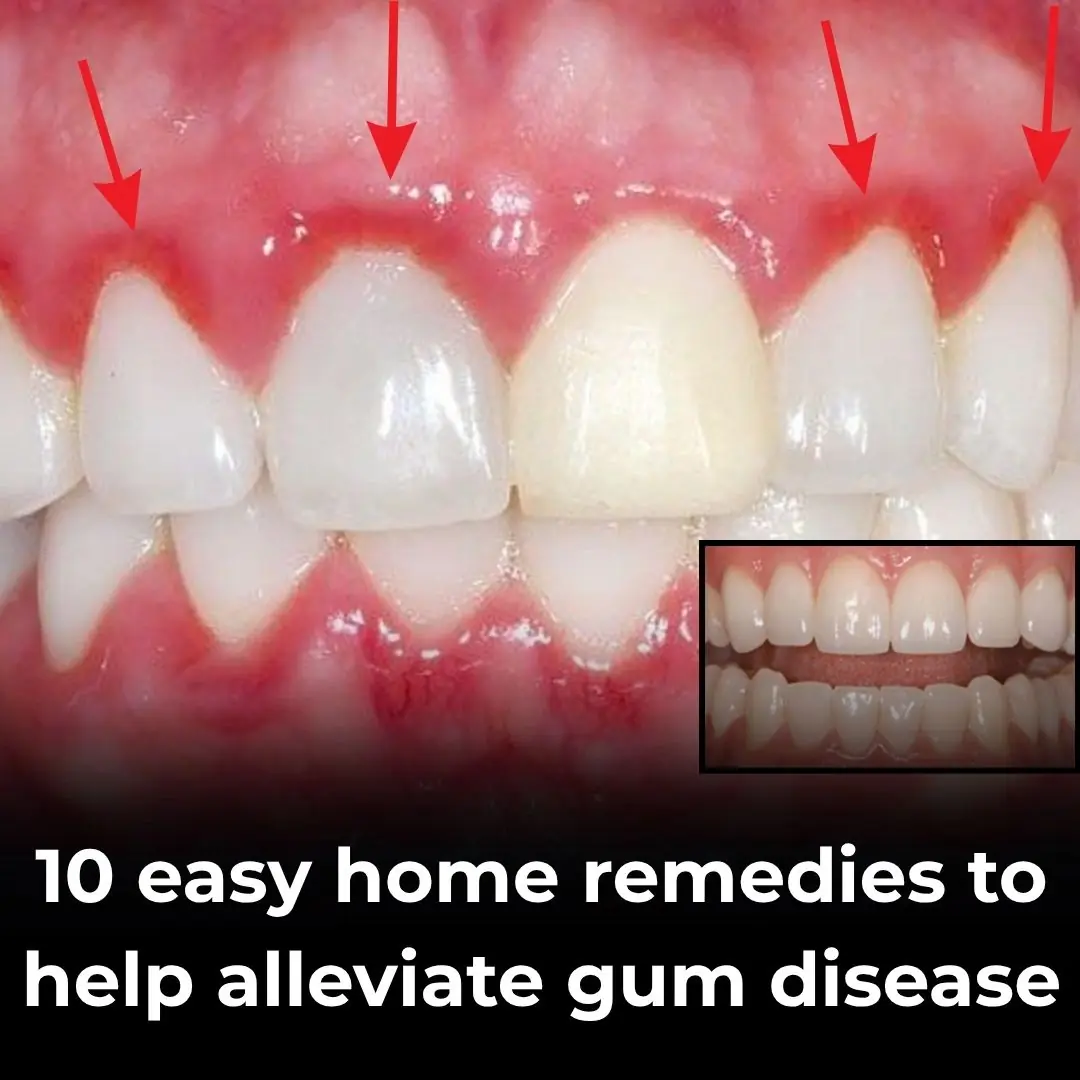 10 Natural Ways to Calm Gum Irritation at Home