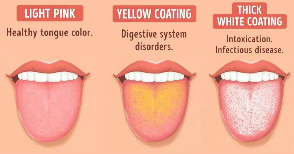 What Your Tongue Can Tell You: 8 Health Clues Written on Your Tongue