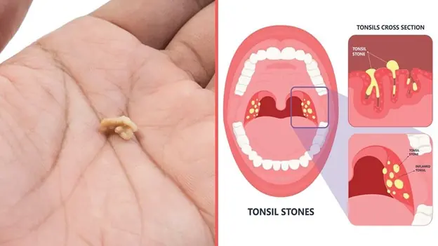Tonsil Stones: Natural Ways to Remove and Prevent Them