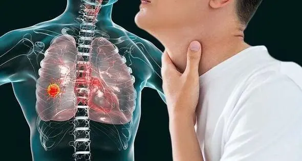 5 Early Signs of Lung Cancer You Shouldn’t Ignore – Metastasis Could Be Life-Threatening