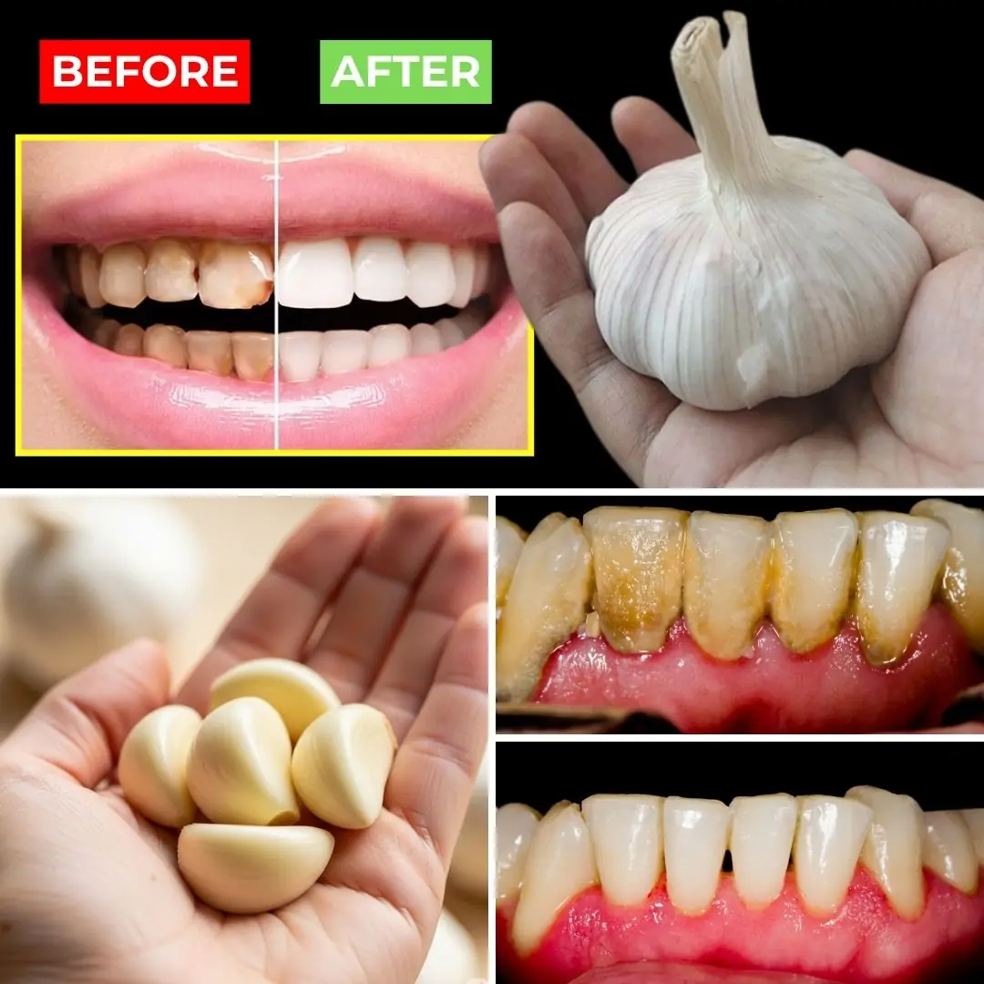 Improve Your Oral Health Naturally with Garlic