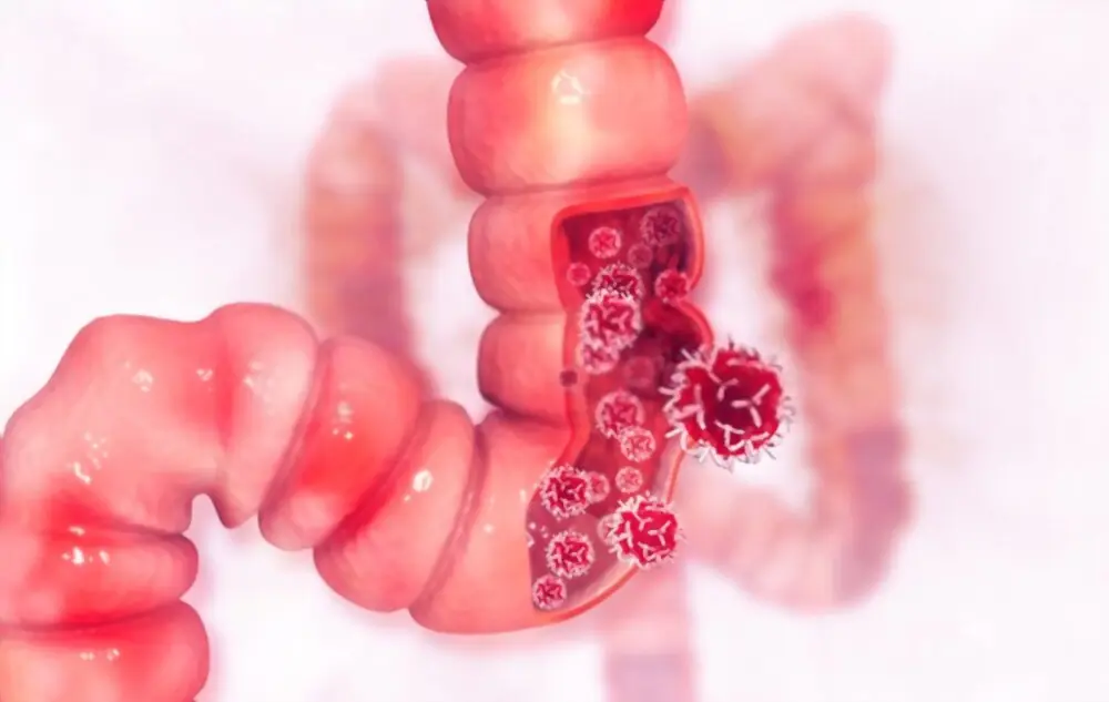 10 Bowel (Colorectal) Cancer Warning Signs You Shouldn’t Ignore