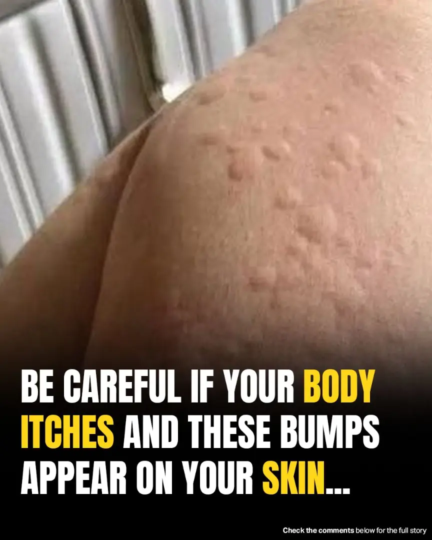 Surprising Causes Of Hives Revealed — What May Be Triggering Your Skin Reaction
