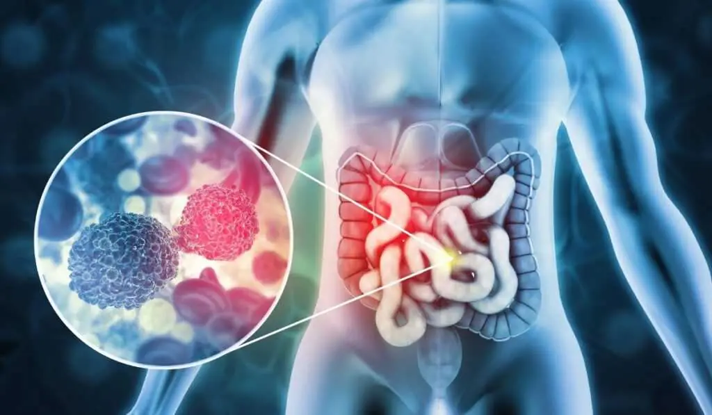 Your Poop and Colon Cancer: Decoding Early Warning Signs