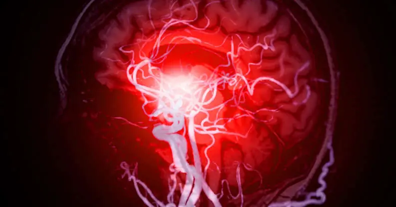 12 Warning Signs That May Signal a Brain Aneurysm — Don't Ignore Them