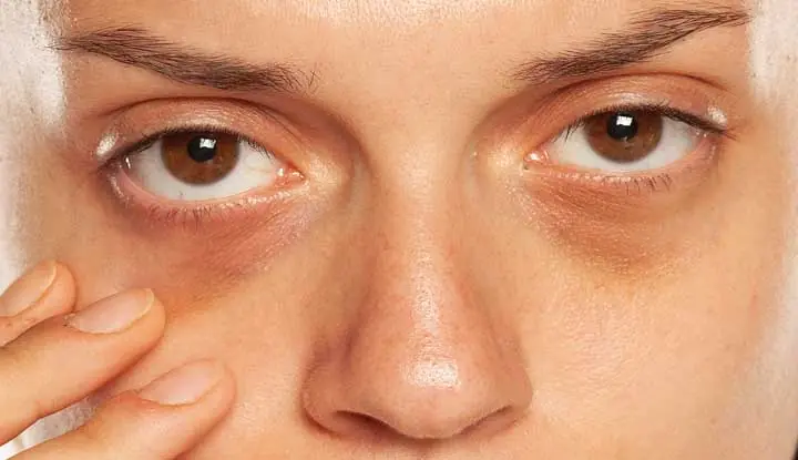 Dark Under-Eye Circles: A Subtle Health Warning You Shouldn't Ignore