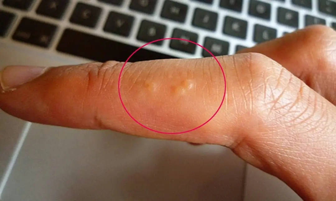 What Are the Tiny Blisters on Your Hands in Summer Trying to Tell You?