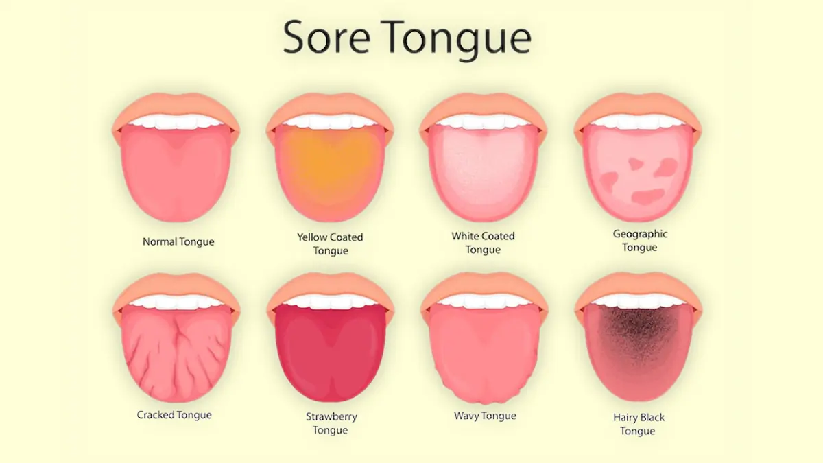 8 Warning Signs Your Tongue May Be Sending About Your Health