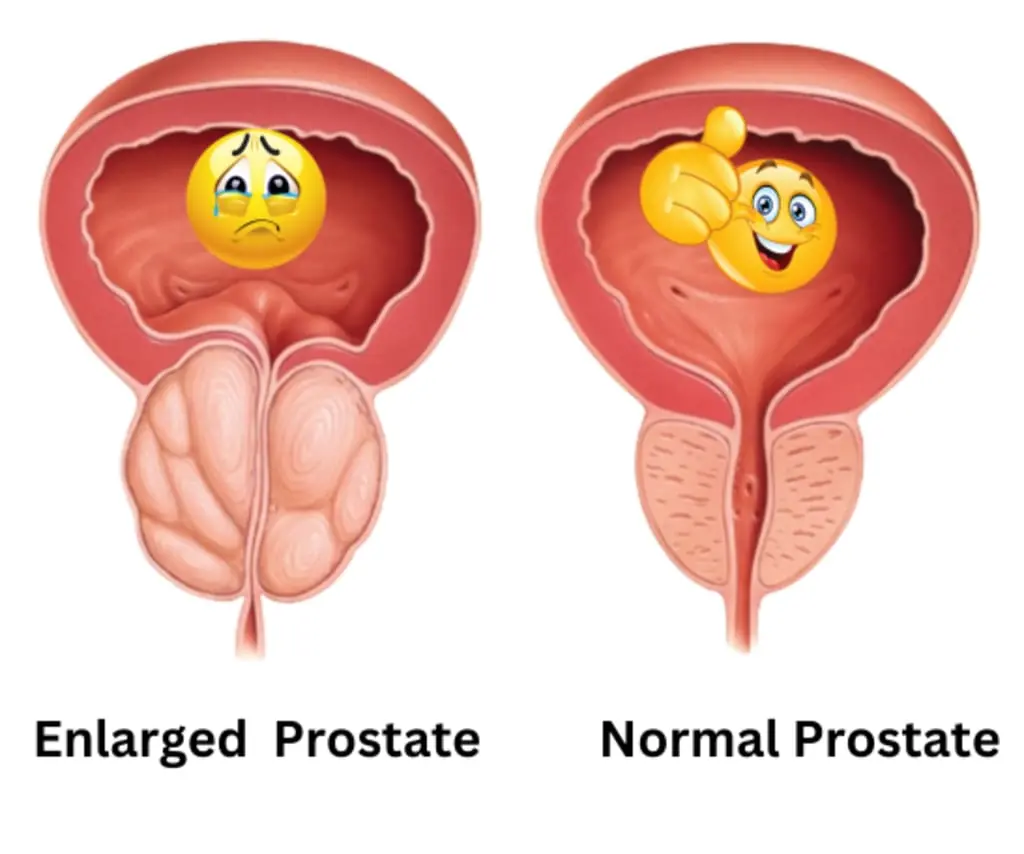 Prostate Cancer: Warning Signs and Symptoms Men Shouldn't Ignore