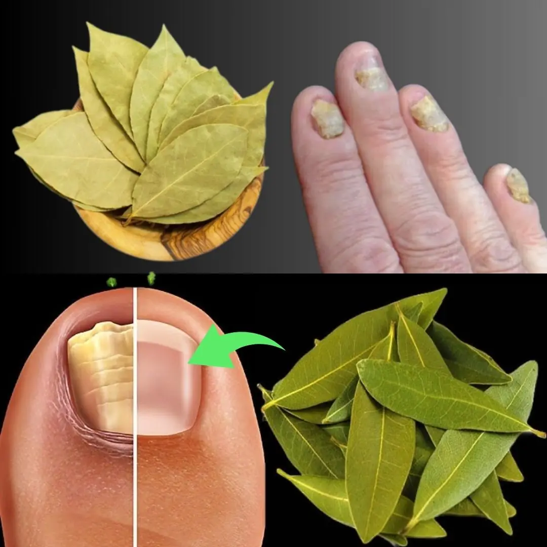 Say Goodbye to Nail Fungus for Less Than $0.50! A Simple Bay Leaf Remedy That Works