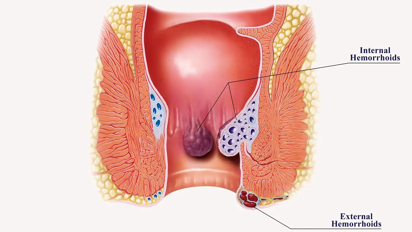 Hemorrhoids: Fast, Effective, Science-Backed Ways to Find Relief